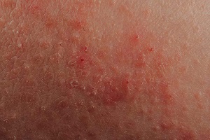 Eczema symptoms