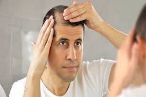 Hair Fall symptoms