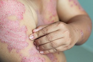 psoriasis symptoms